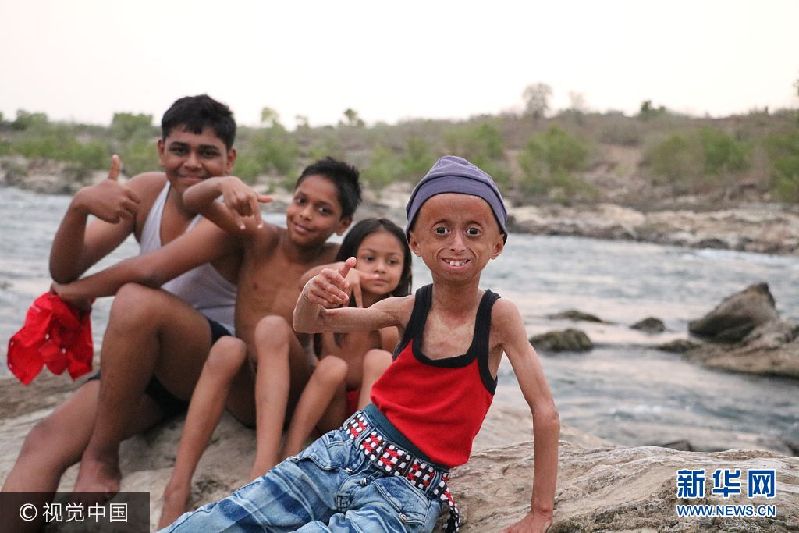 2017年9月11日（具体拍摄时间不详），印度中央邦，来自印度中央邦的11岁男孩Shreyash Barmate外表看起来就像是个老人，这是因为他患有早衰症，衰老速度是同龄人的8倍。虽然只有11岁，Shreyash已经长了皱纹，并且还出现了秃发，四肢也比同龄人要脆弱。尽管很有可能在2年后死去，Shreyash并没有放弃对未来的希望，他唱歌，弹奏乐器，骑自行车，开汽车，也会去游泳。他说自己长大后想成为一名歌手。***_****** EXCLUSIVE *** MADHYA PRADESH, INDIA - SEPTEMBER 2017: Shreyash Barmate, 11, who suffers from Progeria, poses for a picture with his friends and brothers on September, 2017 in Madhya Pradesh, India. An inspirational boy with an ultra-rare genetic condition that makes him look like an old man refuses to let it hold him back ? and even drives a car. Shreyash Barmate, 11 who lives in Madhya Pradesh, India, has progeria ? a condition which causes rapid aging in children. The condition leaves Shreyash suffering from baldness, heavy wrinkles and weakened limbs. The Progeria Research Foundation believe the syndrome is so rare it affects around 1 in 20 million people. PHOTOGRAPH BY Rare Shot / Barcroft Images London-T:+44 207 033 1031 E:hello@barcroftmedia.com - New York-T:+1 212 796 2458 E:hello@barcroftusa.com - New Delhi-T:+91 11 4053 2429 E:hello@barcroftindia.com www.barcroftimages.com PHOTOGRAPH BY Rare Shot / Barcroft Images