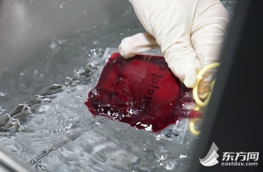 巴基斯坦小伙来沪接受脐带血造血干细胞移植